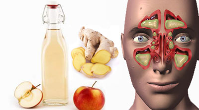 گیاهان دارویی برای سینوزیت