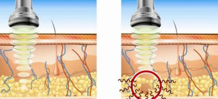 اولتراسونیک, دستگاه لاغری اولتراسونیک
