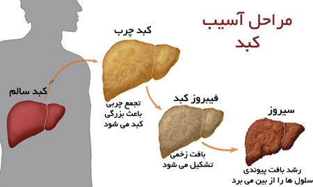 مراحل چرب شدن کبد