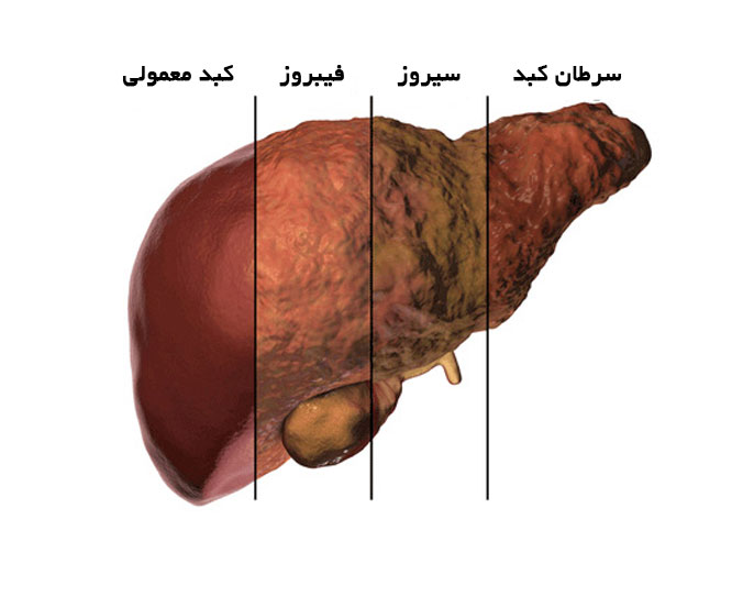 انواع کبد چرب