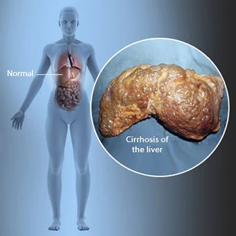 کبد چرب گرید 3