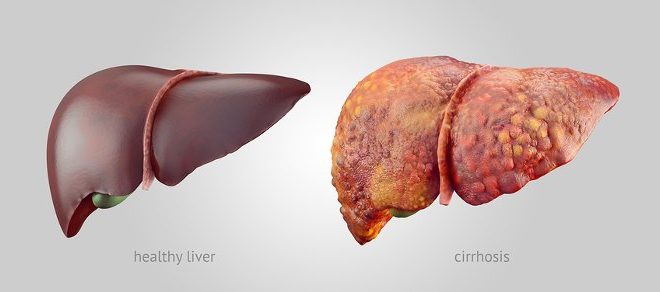 مقایسه کبد چرب و کبد سالم
