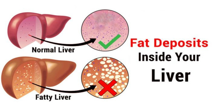 بافت کبد چرب شده
